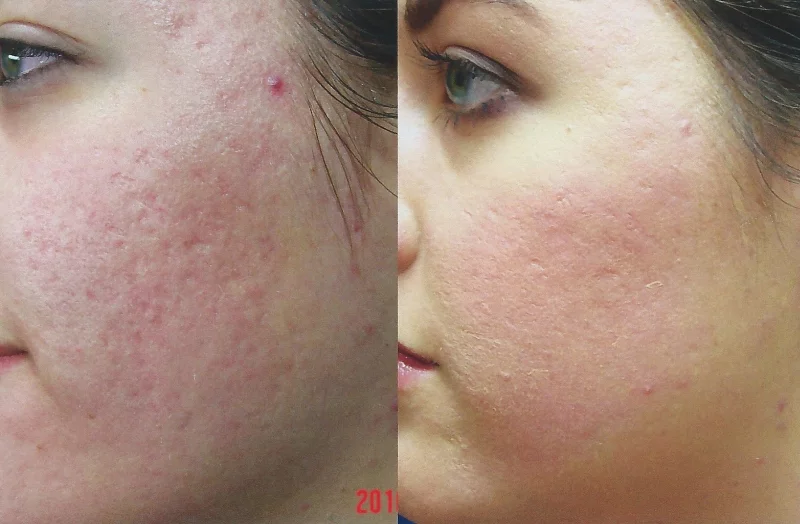 What is Hydrafacial and the device inmportant is it for our skin hyrafacial before and after result